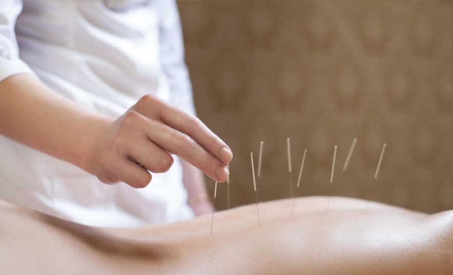 acupuncture
